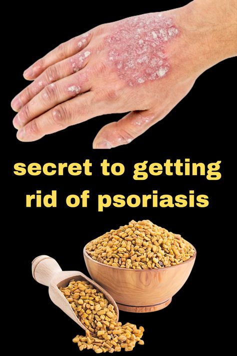 my grandmother's secret to getting rid of psoriasis at home Psoriatic Skin Natural Remedies, Psoriatic Skin Remedies, Psoriatic Skin, Dry Skin Home Remedies, Clean Blackheads, Skin Natural Remedies, Skin Remedies, My Grandmother, Natural Health Remedies