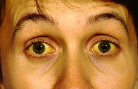 Jaundice Symptoms, Naturopathy, Natural Home Remedies, Natural Treatments, Genetic, Herbal Remedies, Health Problems, Home Remedies, Health Tips