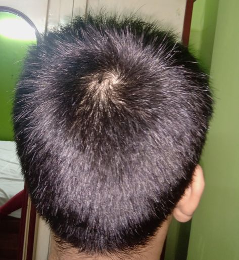 Is it a bald patch or hair whorl ?- ThorGift.com - If you like it please buy some from ThorGift.com Hair Whorl, Bald Patches, Men's Hairstyle, Mens Hairstyles, Hair Styles, Hair