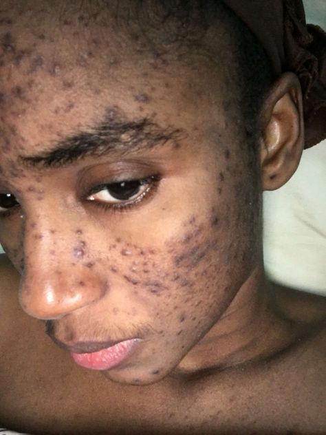 A MODEL claims that her career is ruined thanks to a Swiss skincare line which she alleges scarred her face after it caused severe acne. Mariama Diallo – who won Miss Guinea, Miss West Africa and was a contestant in the Miss World pageant – claims she started using the Makari De Suisse products in […] Celebrities Acne, Celebrities With Acne, People With Acne Pretty, Beautiful Girls With Acne, Acne Pictures, Acne Girls Pretty, Ugly Dress, Mariama Diallo, Skin Care Hyperpigmentation