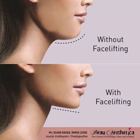 Saggy Face, Face Fillers, Face Surgery, Skin Care Center, Skin And Hair Clinic, Dermatology Clinic, Skin Facts, Instagram Feed Planner, Skin Aesthetics