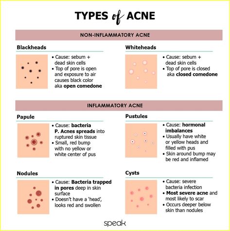 Acne Types And Causes, Acne Types, Different Types Of Acne, Remove Skin Tags Naturally, Skin Care Supplies, Skin Facts, Best Acne Products, Skincare 101, Types Of Acne