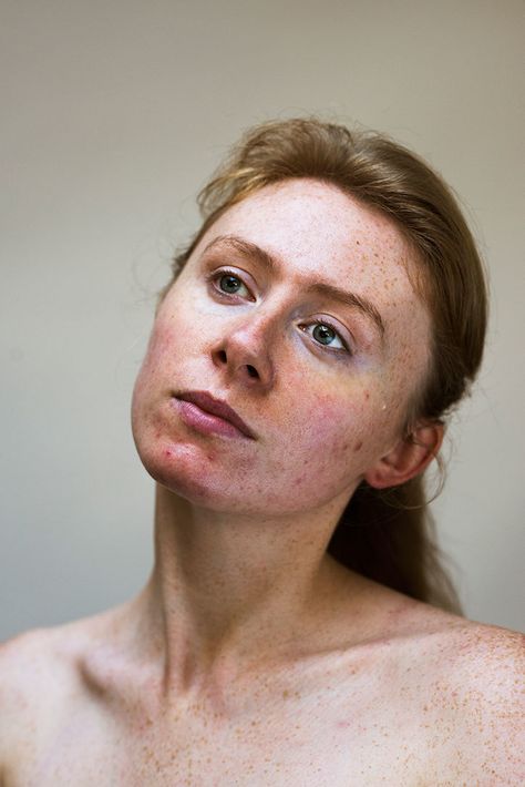 Sophie Harris-Taylor breaks down the stigmas of skin issues with photo series Epidermis Acne Positivity, Skin Positivity, Raw Photography, Severe Acne, Women Skin, Face Photography, Beauty Shoot, Raw Beauty, Photo Series