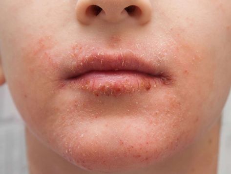 Are you experiencing dry skin around the lips? Check out these home remedies:  https://www.medicalnewstoday.com/articles/325051.php Rash Around Mouth, Remedies For Dry Mouth, Rash On Face, Super Dry Skin, Facial For Dry Skin, Itchy Rash, Proper Skin Care, Cracked Skin, Itchy Skin