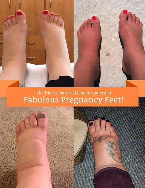 Mama Natural Reader Gallery of Fabulous Swollen Feet During Pregnancy Swollen Feet Pregnancy, Swelling Remedies, Pregnancy Swelling, Pregnancy Spa, Teeth Remedies, Care During Pregnancy, Swollen Ankles, Essential Oils For Pregnancy, Post Pregnancy Workout