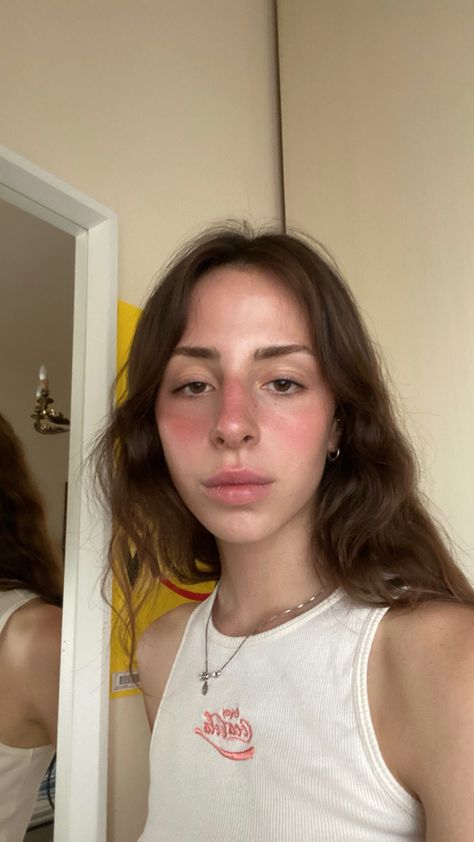 Cute Sunburn Face, Sunburn Aesthetic Face, Sunburnt Face Aesthetic, Sunburnt Blush Look, Sun Burned Face, Sunburned Makeup Look, Sunburn Makeup Look, Sunkiss Makeup, Sunburnt Makeup Look