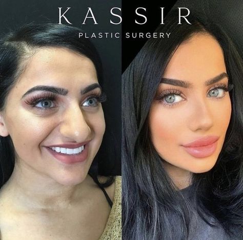 Rhinoplasty Before and After Gallery — Kassir Plastic Surgery in NY and NJ Jaw Reduction Surgery, Nose Plastic Surgery, Face Plastic Surgery, Celebrity Relationships, Plastic Surgery Fail, Rhinoplasty Nose Jobs, Plastic Surgery Gone Wrong, Face Surgery, Rhinoplasty Before And After