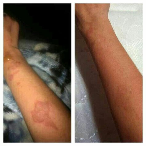 Is this amazing or what? Results from just using our It Works Stretch Mark Cream on a burn scar!! I love our products and this company!! www.wrapit4newyou.myitworks.com Stretch Mark Remedies, Scar Cream, Diy Acne, Stretch Mark Cream, Stretch Mark Removal, Acne Scar Removal, Burn Mark, Stretch Mark, Mascara Tips