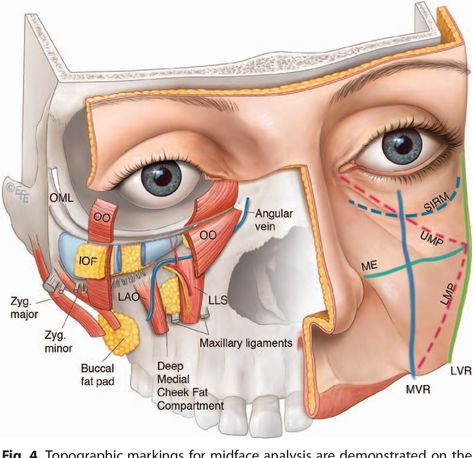 Cheek Injections, Anatomy Of The Face, Cheek Fat, Facial Aging, Methylene Blue, Head Anatomy, Tear Trough, Facial Anatomy, Face Anatomy