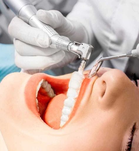 What is Laser Teeth BleachingThe biggest advantage of laser teeth bleaching is that the procedure can be performed in a very short timeIt is a bleaching process performed in a short period of approximately 4 minutes after isolating all soft tissues with a barrier. Wisdom Teeth Removal, Teeth Bleaching, Tooth Removal, Emergency Dentist, Dental Teeth, Dental Cleaning, Tooth Extraction, Dental Problems, Natural Teeth