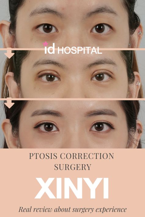 Ptosis correction is used to lift the levator muscles that are responsible for raising the eyelids. For some people, when this muscle is weak, they tend to look tired and sleepy. With this surgery, your eyes will open to their full extent, and give you big, doe-like eyes! #plasticsurgery #koreanplasticsurgery #surgeryinkorea #doubleeyelidsurgery #eyelidsurgery #eyelidsurgerybeforeandafter #eyelidsurgeryrecovery #blepharoplasty #ptosis #ptosiscorrection #Koreaneyesurgery Korean Eye Surgery, Korean Double Eyelid, Indian Diorama, Local Anesthesia, Double Eyelids, Tired And Sleepy, Korean Plastic Surgery, Plastic Surgery Photos, Bigger Eyes