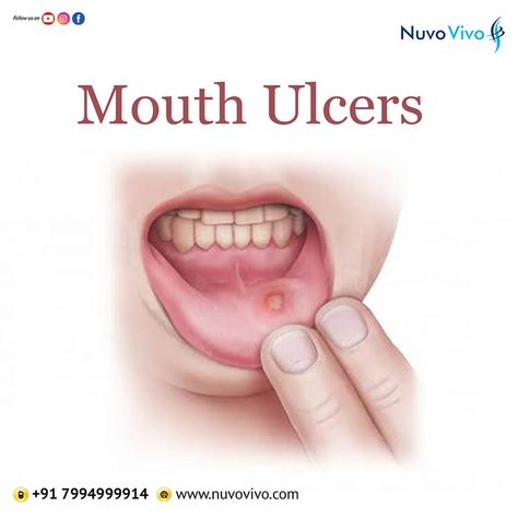 Mouth ulcers (Canker sores) are those painful lesions that occur on the gum, inside of the lips and other areas of the mouth. While most of these sores go away in a week or two, they can make drinking, eating, etc quite uncomfortable. Lifestyle Diseases, Mineral Deficiency, Canker Sore, Irritable Bowel, Food Allergy, Lack Of Sleep, Food Allergies, Home Remedies, Allergies