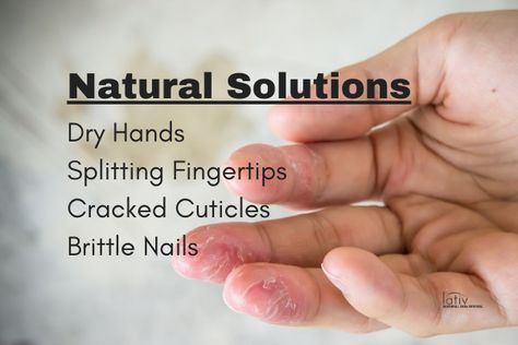 How To Heal Cracked Fingers, Extreme Dry Hands Remedies, Cracked Finger Tips, Dry Cracked Hands Remedy, Cracked Hands Remedy, Wrinkly Hands, Cracked Fingertips, Cracked Fingers, Dry Cracked Cuticles