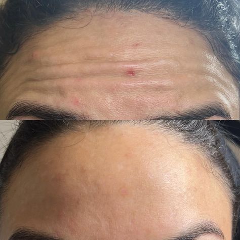 Facial and botox results ✨🫶🏼 Your facial can be done immediately before Botox or two weeks after Botox areas treated: forehead, glabellar (11s), crows feet, and bunny lines #botox #nycinjector #neurotoxin Botox Results, Botox Before And After, Crows, Facial, Canning, Quick Saves