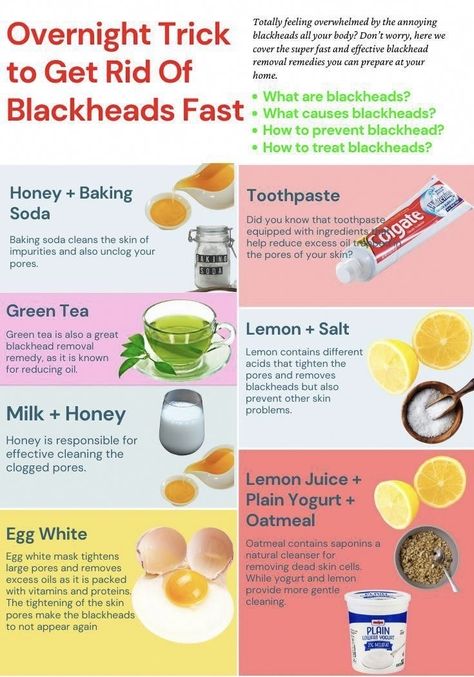 What Causes Blackheads, Remedies For Blackheads, How To Treat Blackheads, How To Prevent Blackheads, Blackhead Remover Diy, For Blackheads, Green Tea Lemon, Blackhead Remedies, Blackheads On Nose