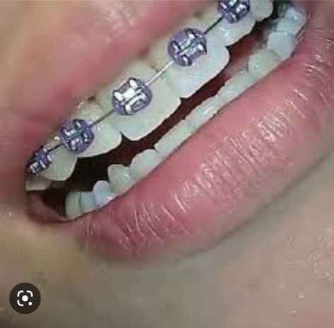 Braces Aesthetic Purple, Braces Ideas Cute, Braces Colors Lavender, Braces Colors Purple, Top Braces Only Teeth, Violet Braces, Light Purple Braces, Dark Purple Braces, Lilac Braces