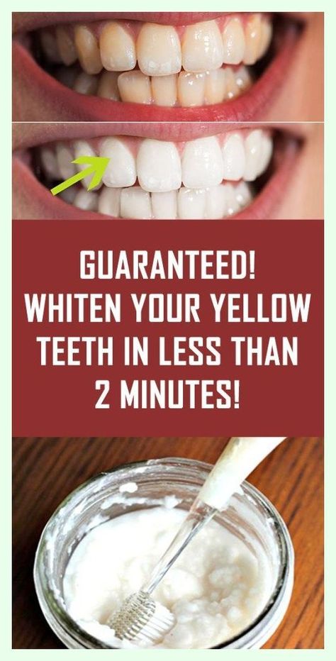 GUARANTEED! Whiten Your Yellow Teeth In Less Than 2 Minutes! Teeth Whitening Homemade, Yellow Teeth, Teeth Health, Best Teeth Whitening, Natural Teeth Whitening, Natural Teeth, White Teeth, Teeth Cleaning, Oral Health