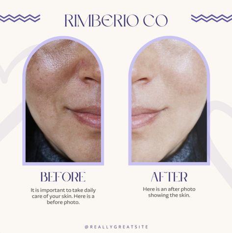 Before And After Social Media Design, Before And After Poster Design, Before And After Instagram Post Design, Before And After Template Design, Before After Skincare, Before And After Template, Before And After Skincare, Medical Branding, Skincare Design