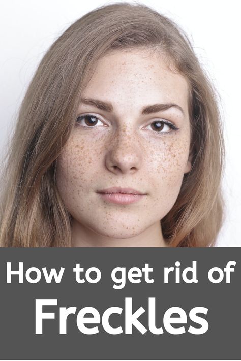 How To Get Rid Of Freckles On Face, How To Get Rid Of Freckles, How To Remove Freckles, Getting Rid Of Freckles, Freckle Remover, Diy Remedies, Daily Skin Care Routine, Beauty Secrets, Natural Skin