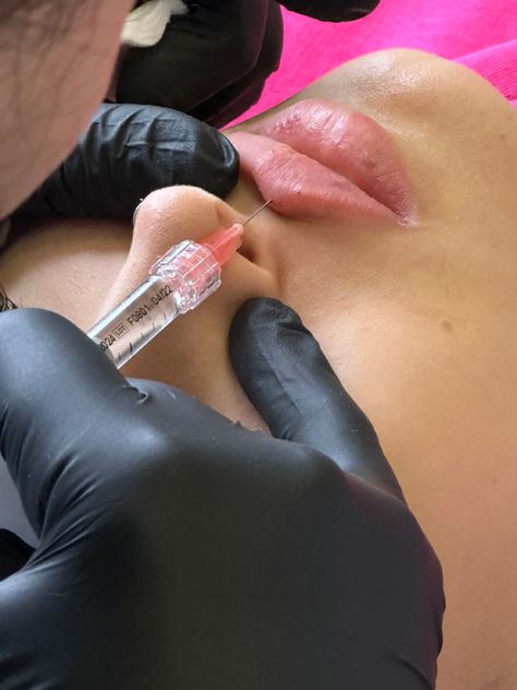 Dermal Fillers Lips, Aesthetic Nurse, Botox Lips, Nurse Aesthetic, Lip Wallpaper, Skin Aesthetics, Cosmetic Injectables, Facial Aesthetics, Injectables Fillers