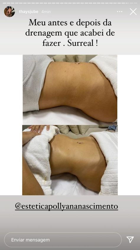 Liposculpture Before And After, Lipo 360 Before And After, Lipo 360, Lipo Before And After, Body Surgery, Body Contouring Surgery, Massage Pictures, Beauty Careers, Esthetician Marketing