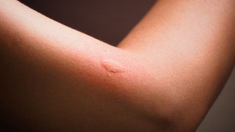 https://beautytap.com/2020/07/top-natural-remedies-for-healing-bug-bites/ Bug Bite Swelling, Allergic To Mosquito Bites, The Ordinary Alpha Arbutin, Ant Bites, Differin Gel, Calamine Lotion, Hydrocortisone Cream, Tick Bite, Bed Bug Bites