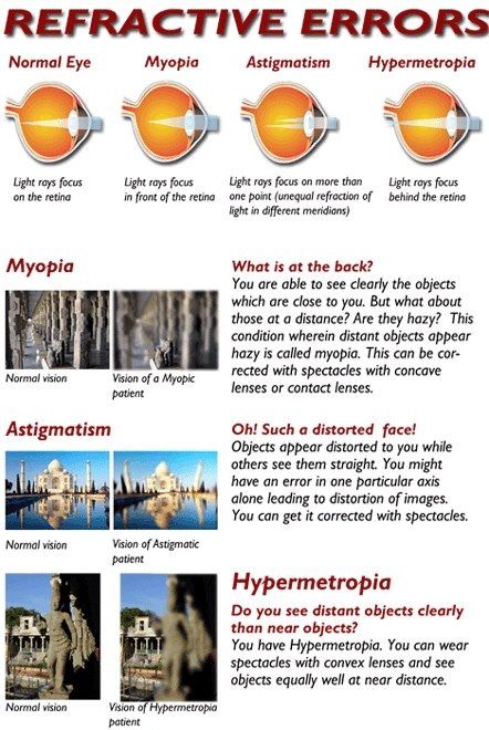 How eye shape affects vision. Myopia= Mile-long Vision Impairment (Distance-Vision Impaired); Hyperopia= Here Vision (Near-Vision Impaired). Someone with myopia will need to wear corrective lenses to see anything far away, such as a whiteboard in a classroom, while someone with hyperopia will need reading glasses for close-up vision, such as reading a textbook. Astigmatism= Abnormal Eye Shape, which impacts the way the eye is able to refract light, & may cause myopia, hyperopia, or both. Ophthalmic Assistant, Opthalmic Technician, Ophthalmic Technician, Refractive Errors, Optician Training, Optometry Education, Eye Facts, Eye Anatomy, Vision Therapy