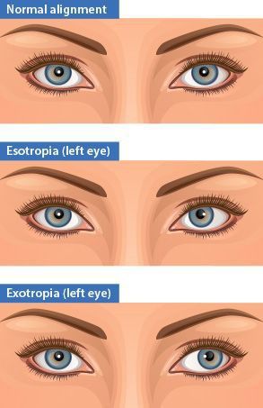 Vision Therapy Exercises, Strabismus Surgery, Ophthalmic Technician, Optometry Education, Crossed Eyes, Good Eyesight, Perceptual Activities, Human Skeletal System, Visual Perceptual Activities