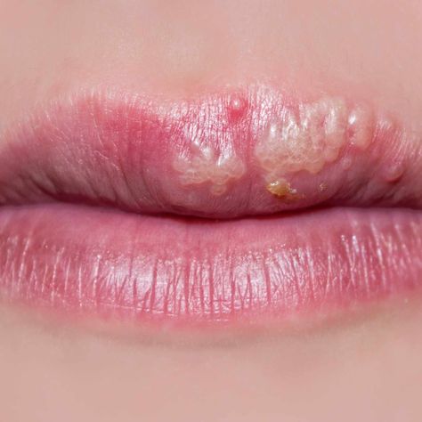 a close-up of a woman's lips, with cold sores Cold Sore On Lip, Cold Sores On Lips, How To Stop A Cold Sore Before It Starts, Best Cold Sore Remedy Overnight, Lip Sores, How To Heal A Cold Sore Fast, How To Prevent Cold Sores, Remedies For Cold Sores Lips, Home Remedy For Cold Sore On Lip