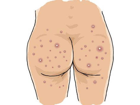 Boils On Buttocks, How To Treat Boils, Overnight Acne Remedies, Remedies For Acne, Pimples Remedies, Home Remedies For Acne, Beauty Diy, Cystic Acne, Body Hacks