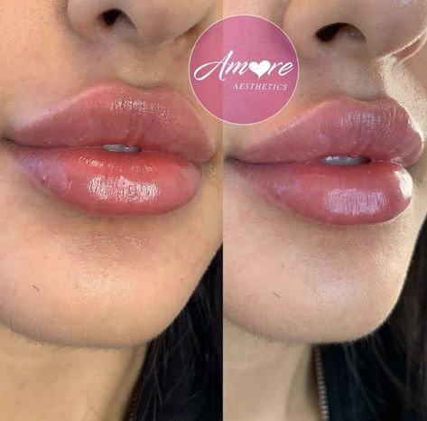 Big Lip Filler, Lip Fillers Shapes Natural, Lip Filler Shape Ideas, Lip Fillers Juvederm, Get Fuller Lips Naturally, Dermal Fillers Lips, Fuller Lips Naturally, Cosmetic Tattooing, Lips Inspiration