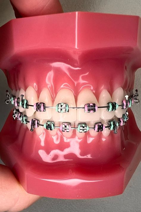 Pink And Green Braces, Braces Combination Colors, Braces Band Colors, Green Braces Color, Mint Braces, Mint Green Braces, Summer Braces Colors, Light Pink Braces, Braces Combos