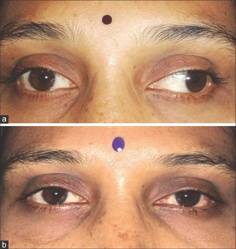 Strabismus surgery guide Strabismus is more than just a cosmetic flaw; it can cause severe, irreversible vision impairment. Typically, early childhood surgery can prevent this development. When the eyes are misaligned as a result of squinting, the two resulting images are so far apart that the brain cannot merge them into a single spatial image. […] The post Strabismus surgery guide appeared first on Laser Eye Color Change Turkey without Surgery . Eye Color Change Surgery, Strabismus Surgery, Eye Beautiful, Lazy Eye, Laser Eye, Eye Surgery, My Vision Board, The Brain, Early Childhood