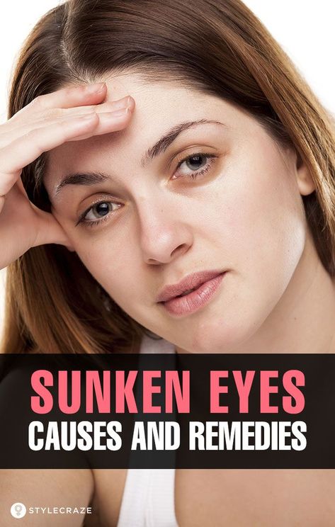 Sunken Eyes – Causes And Remedies: Sunken eyes mainly appear with aging and can happen due to many reasons. These reasons can be external, like stress and tension, or internal, like lack of sleep, dehydration, and improper diet. Read on to know more about which home remedies to use for sunken eyes. #eyecareeyes #skincare #eyesskin #eyemakeup #eyeshadowlooks #eyebrows Whiten Underarms Fast, How To Whiten Underarms, Sunken Eyes, Remove Dark Circles, Eyes Problems, Natural Cough Remedies, Lose 40 Pounds, Puffy Eyes, Eye Health