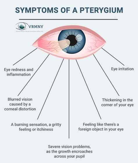 Tip on How to Get rid of a Stye Overnight Opthalmic Technician, Optician Training, Optometry Education, Eye Medicine, Eye Facts, Eye Problems, Vision Eye, Vision Problems, Healthy Eyes