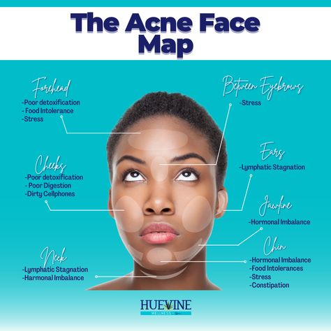 On a Monday, and you got an ACNE? 🙅 🙅 Here's a guide in understanding better why are you getting it and where these tiny tiny acnes are lingering. 😎 💥 Jawline Pimple breakouts in your jawline are a variant indicator that your reproductive health and hormones are out of whack. 💥Chin Area You might need to check your gut, or perhaps you need to improve your detoxification. Check your carb intake 👌 💥 Between the Eyebrows Lack of sleep and stress is your culprit! 💥 Forehead Hmm, consider re- Pimple Location Meaning, Chin Acne Causes, Jawline Acne, Head Acne, Face Mapping Acne, Forehead Acne, Face Mapping, Poor Digestion, Acne Causes