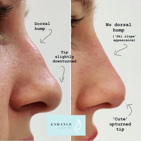 Nose enhancement to camouflage the dorsal hump 👃🏽 Ski Slope Nose, Hump Nose, Slope Nose, Nose Filler, Nonsurgical Nose Job, Nose Plastic Surgery, Nose Surgery Rhinoplasty, Nose Fillers, Drawing Nose