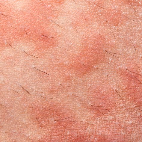 Eczema http://www.womenshealthmag.com/beauty/types-of-rashes/slide/2 Types Of Skin Rashes, Common Skin Rashes, Types Of Rashes, Treating Cystic Acne, Itchy Rash, Home Remedies For Skin, Flaking Skin, Cystic Acne, How To Treat Acne