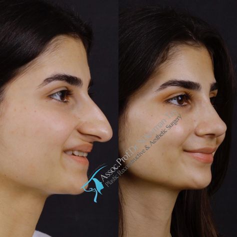 Nose Goals, Forensic Art, Nose Surgery Rhinoplasty, Cheek Implants, Hooked Nose, Plastic Surgery Fail, Nose Jobs, Beautiful Nose, Rhinoplasty Nose Jobs