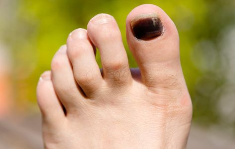 5 Causes of Black Toenails—and How to ID the Harmless From the Harmful | Runner's World Black Toenail Fungus, Black Toenails, Rutabaga Recipes, Black Toe Nails, Nail Falling Off, Church Picnic, Nail Pictures, Ingrown Toe Nail, Toenail Fungus