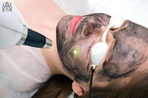 Laser Carbon Peel Carbon Peeling Laser, Carbon Peel, Chemical Peels, Facial Rejuvenation, Large Pores, Chemical Peel, Clean Face, Clogged Pores, Dull Skin