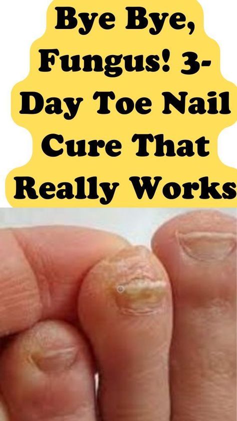 fungal nail treatment Toe Nail Fungal Infection, Ugly Toenails, Yellow Toe Nails, Toenail Health, Toenail Fungal Infection, Nail Remedies, Fingernail Fungus, Toenail Fungus Remedies, Nail Infection