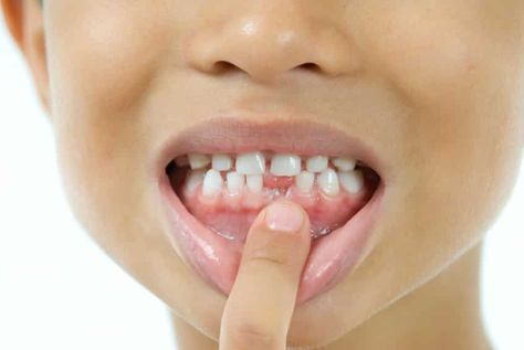 How To Pull Out A Loose Tooth, Pediatric Dentistry Office, Dentistry Office, Dairy Free Breastfeeding, Tooth Pulled, Loose Tooth, Oil Pulling, Pediatric Dentistry, Loose Tees