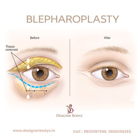 Belfaroplasty Eyes, Blephoraplasty Surgery, Eyes Surgery, Eye Bag Surgery, Facial Injections, Eyelid Lift, Facial Fillers, Good Morning Flowers Quotes, Eye Surgery