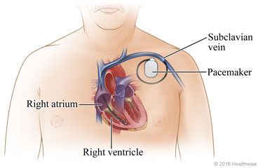 Pacemaker Surgery, Shortness Of Breath Causes, Bed Sores, Types Of Surgery, Blood Vessels, Medical Care, Surgery, Nursing, How Are You Feeling