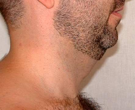 Bizarre.  Tiny round chin with awkward skin hanging from the neck.  The chin creates a line with the neck, but only just below.  Jawline almost nonexistant. Fat Burning Excercise, Why Men Cheat, Unwanted Hair Growth, Baby Feeding Schedule, Dark Underarms, Polycystic Ovaries, Excess Hair, Productive Things To Do, Home Beauty Tips