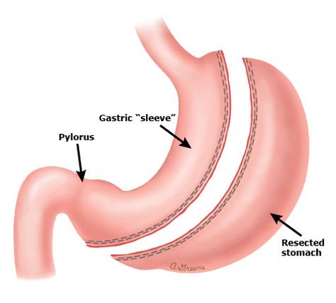 Sleeve gastrectomy PI - UpToDate Bariatric Sleeve, Gastric Band, Bariatric Surgeon, Sleeve Gastrectomy, Sleeve Surgery, Fit Girl Motivation, Gastric Bypass, Please Wait, Side Effects