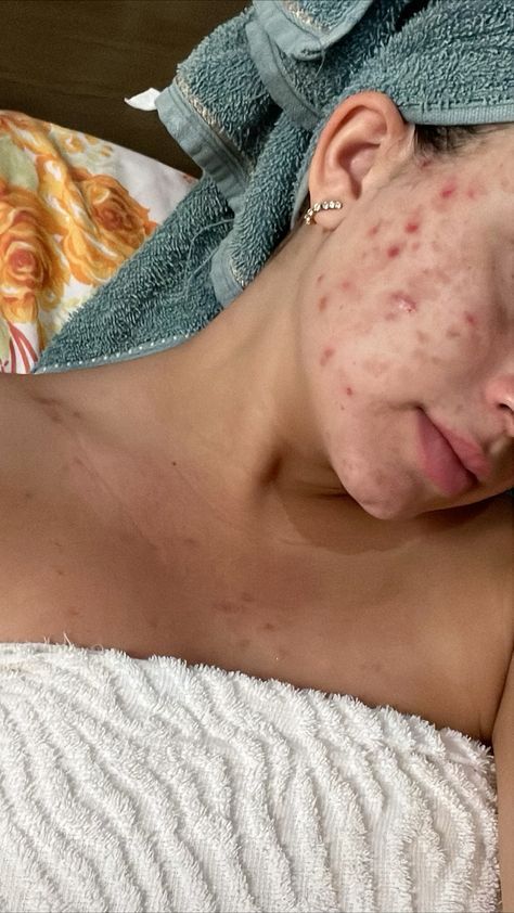 Acne Face Aesthetic, Bad Skin Pictures, Body Acne Positivity, Pimples Aesthetic, Acne Skin Aesthetic, Bad Acne Pictures, Girls With Acne, Acne Appreciation, Strawberry Freckles