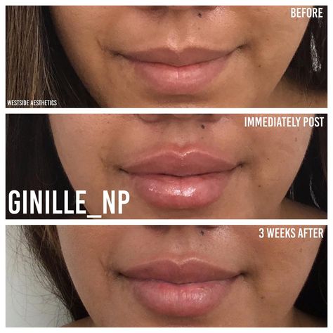 Lip Filler Shapes, Bigger Lips, Botox Filler, Small Lips, Lip Filler, Botox Fillers, Lower Lip, Upper Lip, Lip Fillers