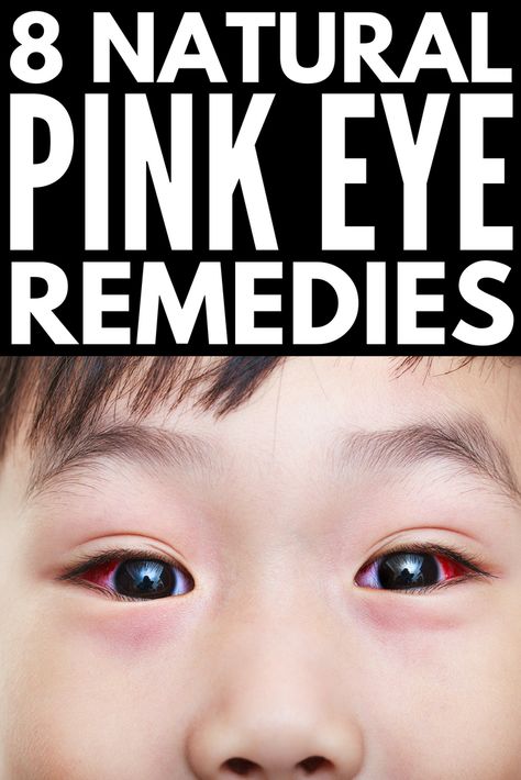 Pink Eye Remedies, Remedies For Pink Eye, Natural Pink Eye Remedy, Pinkeye Remedies, Irritated Eye, Ginger Benefits, Pink Eye, Pink Eyes, Health Problems